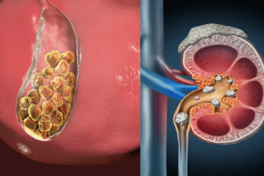 Penyebab Batu Empedu Akibat Diet Modern dan Gaya Hidup Instan