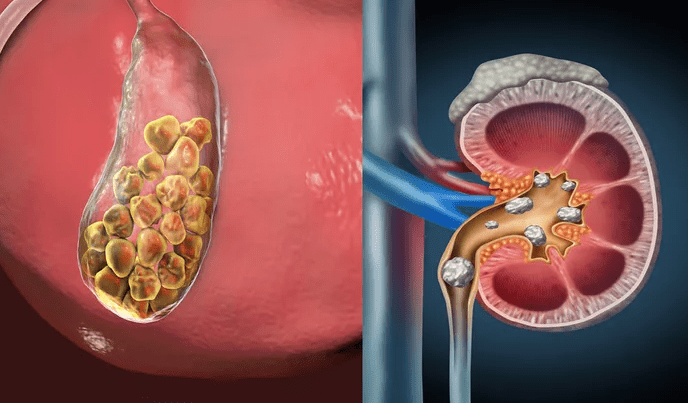 Penyebab Batu Empedu Akibat Diet Modern dan Gaya Hidup Instan